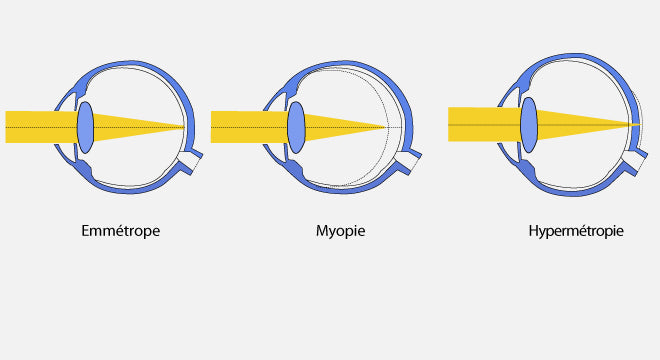 Les Amétropies Visuelles : Comprendre le défaut de votre vue